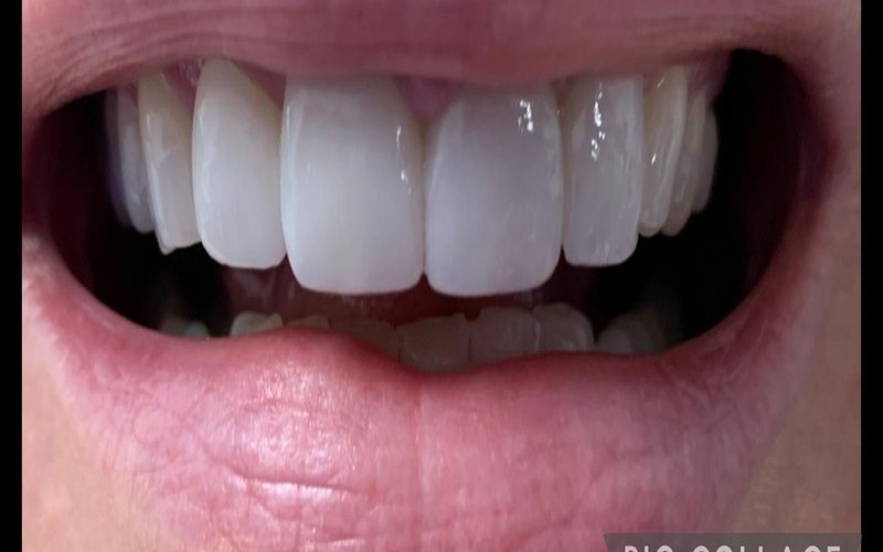 After composite bonding case 2 at Tower Dental Blackpool
