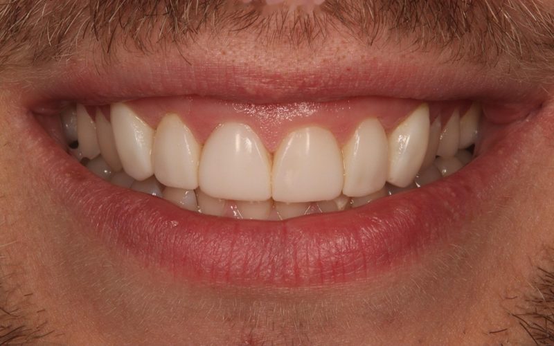 After: composite bonding restoring an even, natural front-tooth edge at Tower Dental Blackpool