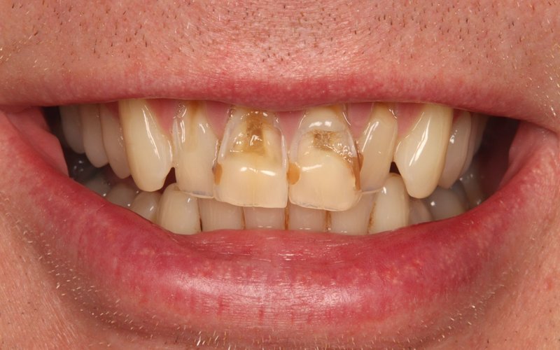 Before composite bonding at Tower Dental Blackpool