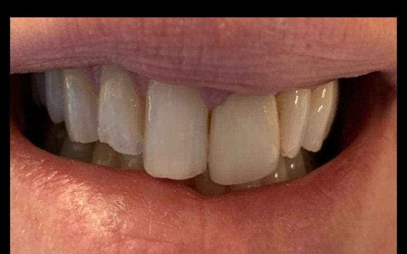 Before composite bonding case 2 at Tower Dental Blackpool