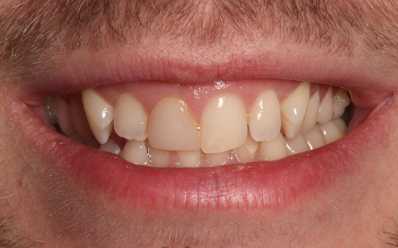 Before: worn, chipped and uneven front teeth at Tower Dental Blackpool