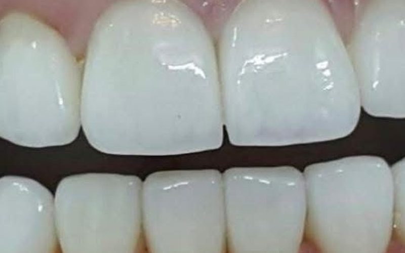 After cosmetic dentistry at Tower Dental Blackpool