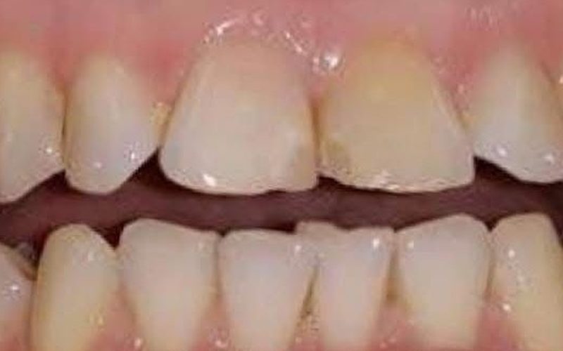 Before cosmetic dentistry at Tower Dental Blackpool