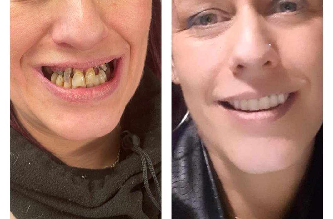 Before and after dentures at Tower Dental Blackpool
