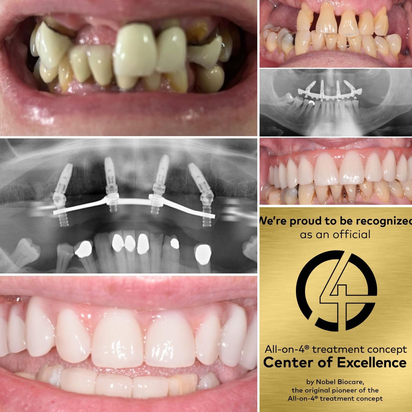 Before and after All-on-4 dental implant treatment by Dr San Chatterjee at Tower Dental Blackpool, with X-ray showing four implants supporting a full arch