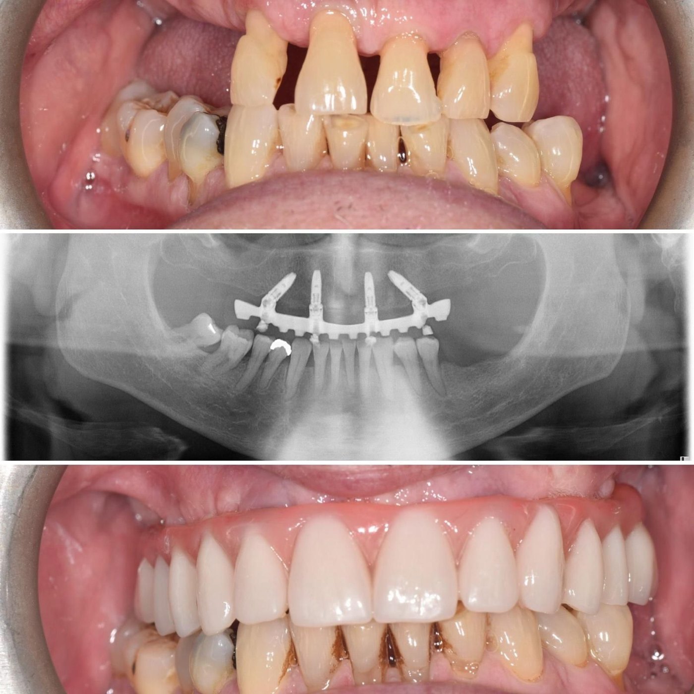 Before and after full-mouth dental implant treatment by Dr San Chatterjee at Tower Dental Blackpool, with X-ray showing the implant-supported bridge